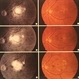 Orbital Fat Invasion, melanoma.